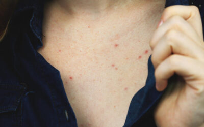 Granos en el pecho: ¿Por qué salen?