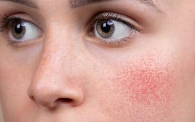 Rosácea: Guía Completa