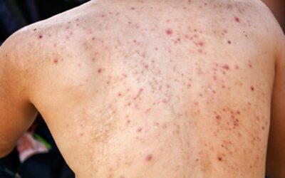 Foliculitis después de la depilación láser