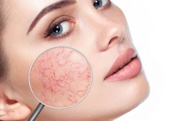 Arañas vasculares: Qué debes saber