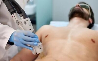 Precio depilación láser hombre