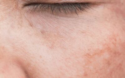 Manchas de sol por depilación láser: Cómo evitarlas y quitarlas