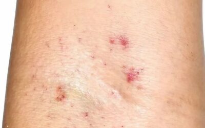 Petequias en las piernas