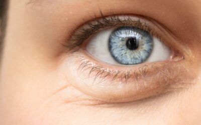 Ácido hialurónico para ojeras: La guía completa