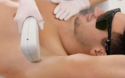 Tendencias en depilación láser masculina