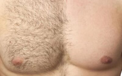 Cómo eliminar el vello corporal en hombres