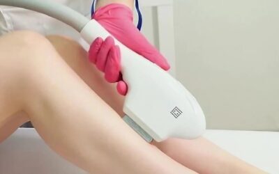 ¿Cómo afecta retrasar la depilación láser a los resultados?