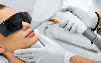 Depilación láser de bozo