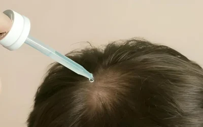 Medicamentos contra la alopecia y depilación láser: ¿Compatibles?