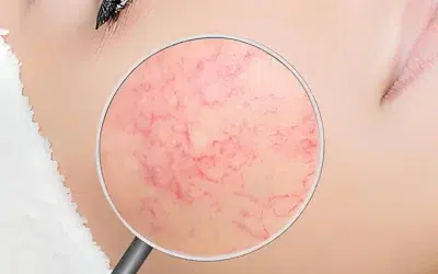 ¿Puedo hacerme la depilación láser si tengo rosácea?