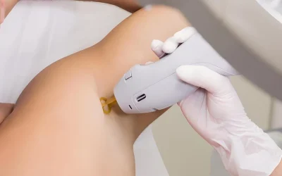 ¿Cómo prolongar la eficacia de la depilación láser de diodo?