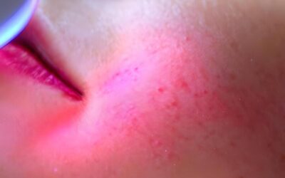 Cambios en el pH de la piel tras la depilación láser